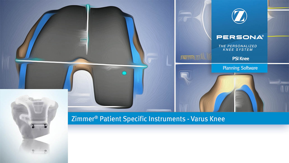 Zimmer® PSI Knee Planning Varus Knee