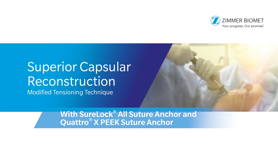 Superior Capsule Reconstruction Modified Tensioning Technique