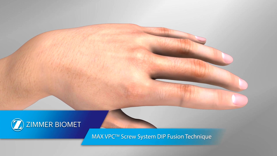 MAX VPC™ Screw System DIP Fusion Technique